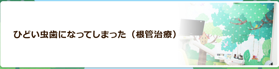 ひどい虫歯になってしまった（根管治療）